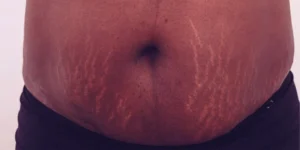 درمان ترک پوستی