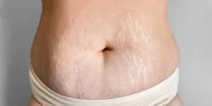 درمان ترک پوستی